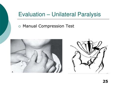 Vocal Cord Paralysis Lateral Manual Compression Test